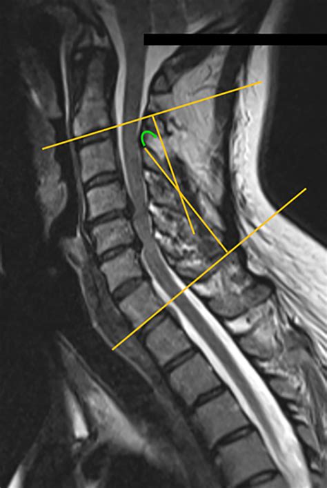 Cervical Spine Mri Demonstrating Spinal Cord Impingement At The C C ...