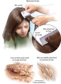 Head Lice | Dermatology | JAMA | JAMA Network