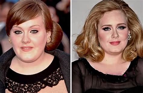 Adele’s Before and After Surgery Photos Show Proof of the Singer’s ...