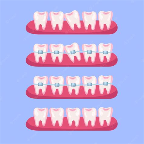 Free Vector | Teeth before and after braces cartoon illustration set ...