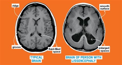 Lissencephaly