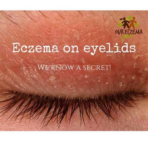 Eczema On Eyelids - We Know A Secret | Eczema on eyelids, Eczema ...