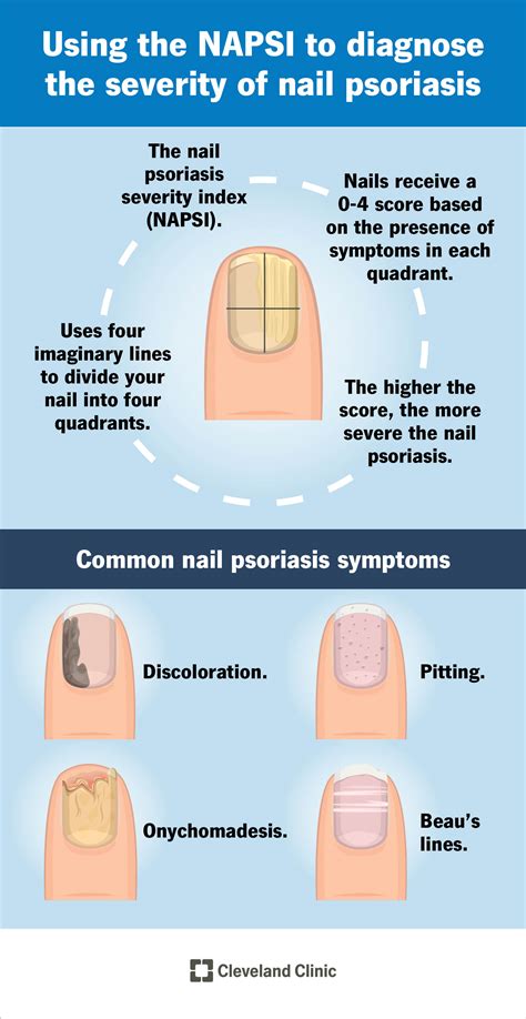 Nail Psoriasis: What It Is, Causes, Nail Pitting, Treatment