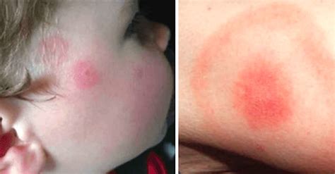 Her Son's Lyme Disease Is Almost Mistaken For A Simple Rash After His ...