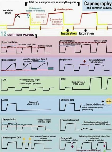 Pin by Pittsburgh Princess on eeg/ekg | Nurse anesthesia, Emergency ...