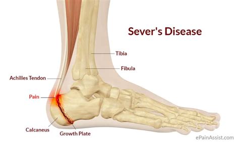 Calcaneal Apophysitis Severs Disease - Leading Gold Coast Podiatrist ...