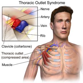 Thoracic outlet syndrome - Wikipedia