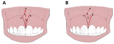 IJERPH | Free Full-Text | Laser Surgical Approach of Upper Labial ...