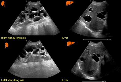 Ultrasound features of Kidney Cysts - Renal Fellow Network