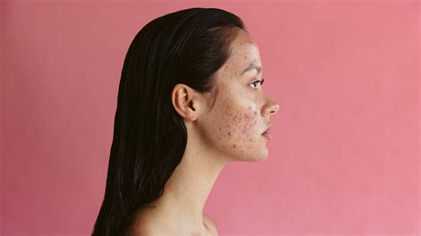 Adult Acne: Causes, Treatment, and Prevention - GoodRx