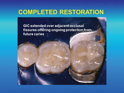 Glass Ionomer Can Be Used for Class Restorations