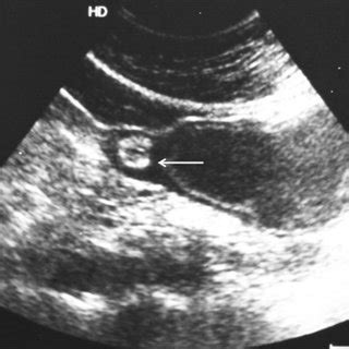 A two-layered pattern of the wall of the duplication cyst is visible on ...