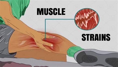 Muscle Strains: Symptoms, Causes, and Treatment • Bodybuilding Wizard