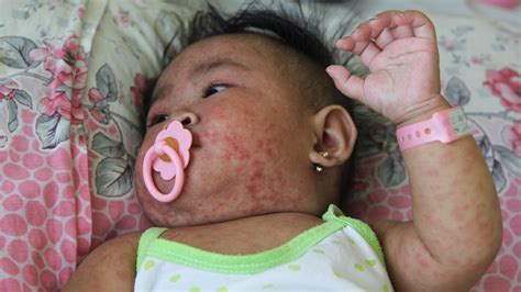 The Philippines Is Fighting One Of The World's Worst Measles Outbreaks ...