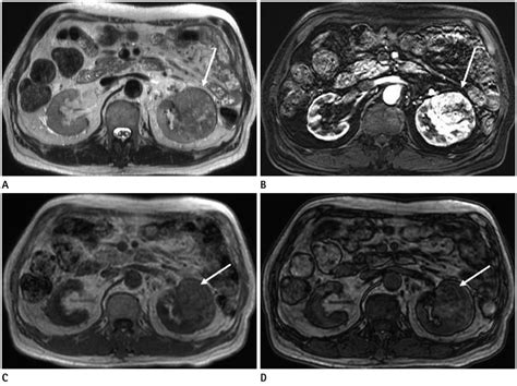 Current MR Imaging of Renal Cell Carcinoma