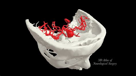 Anterior communicating artery aneurysm - 3D model by 3D Atlas of ...