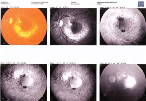 Fluorescein angiography of the left eye of the patient in the initial ...