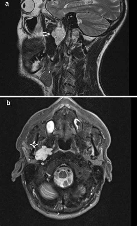 a Parasagittal MRI view of a parapharyngeal pleomorphic adenoma (arrow ...