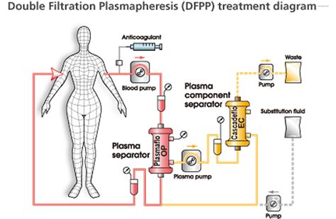 Plasmapheresis - Indications, Plasmapheresis Side Effects