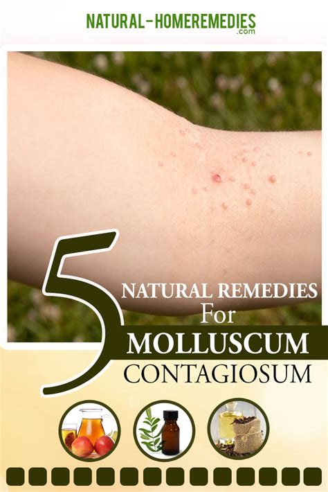 5 Natural Cures For Molluscum Contagiosum - How To Cure Molluscum ...