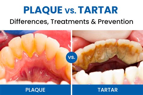 Plaque vs. Tartar: Differences, Treatments & Prevention