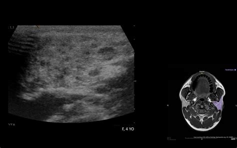 Acute parotiditis. F, 4 YO, presenting with right painful parotid ...