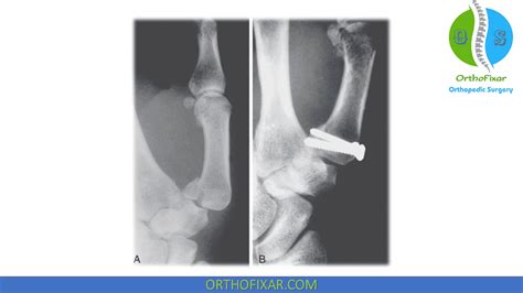 Bennett Fracture Overview | OrthoFixar 2024