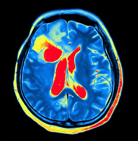 PET Tracer for Parkinson's Diagnosis to Be Tested in... | Brain ...