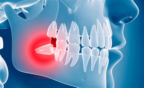 Muelas del Juicio: Síntomas y tratamientos