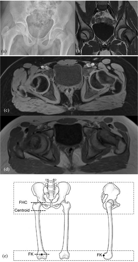 Assessment of femoral retroversion on preoperative hip magnetic ...