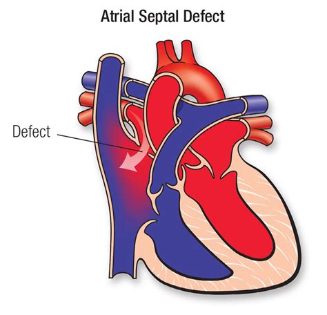 Atrial Septal Defect (ASD) | American Heart Association