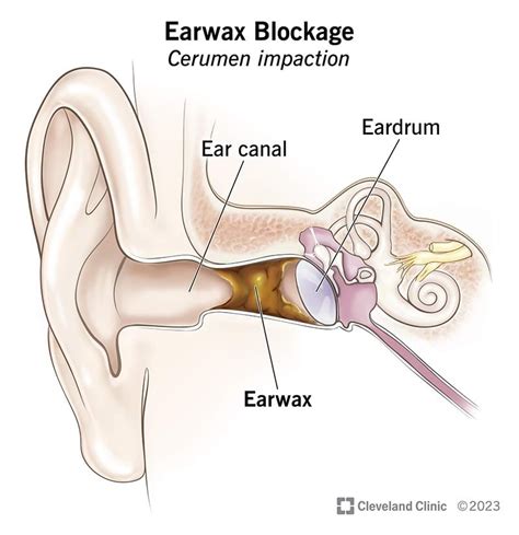 Earwax Blockage: Symptoms, Causes & Removal