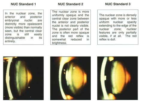 How to diagnose and grade cataracts - EyeGuru