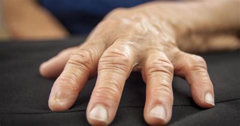 Symptoms of Rheumatoid Arthritis in the Hands and Fingers | LIVESTRONG.COM