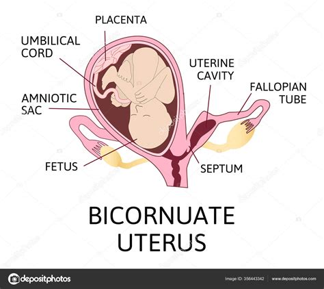 Bicornuate Uterus Pregnancy One Uterine Fetus Child Second Uterine ...