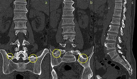 Bilateral Bertolotti's Syndrome: A Case Report of an Uncommon ...