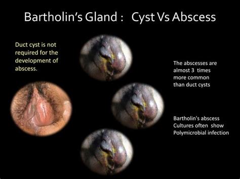 Bartholin gland cyst | PPT