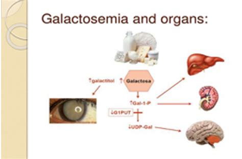 Galactosemia