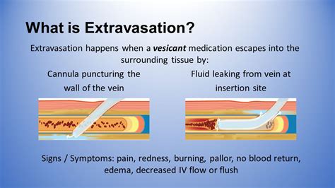 Sensing Technologies For Extravasation Detection: A Review, 45% OFF