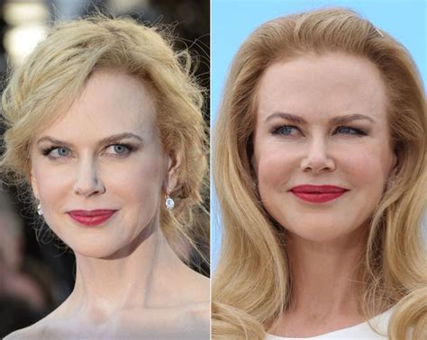 Nicole Kidman before and after plastic surgery (21) | Celebrity plastic ...