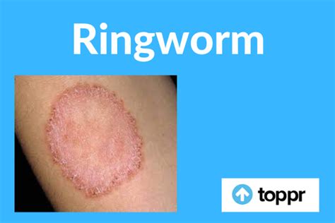 Ringworm: Symptoms, Treatment, Diagnosis, FAQs