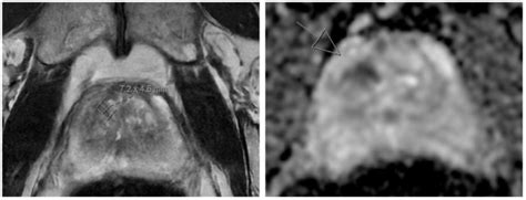 Multiparametric MRI of the prostate. The image on the left is a ...