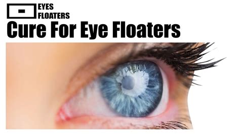 Cure For Eye Floaters - YouTube