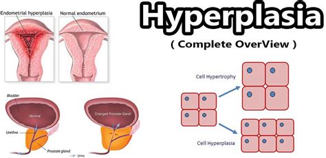 Hyperplasia definition, congenital adrenal, endometrial & prostatic ...