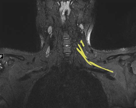 Post-COVID pain or weakness? MRI can pinpoint nerve damage ...