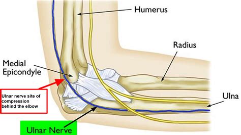 Ulnar Nerve Entrapment Cubital Tunnel