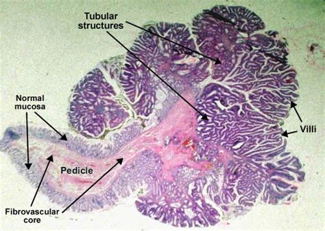 موقع الدكتور أحمد كلحى: صور باثولوجى - ﻿Patholgy Slides : Tumors or ...