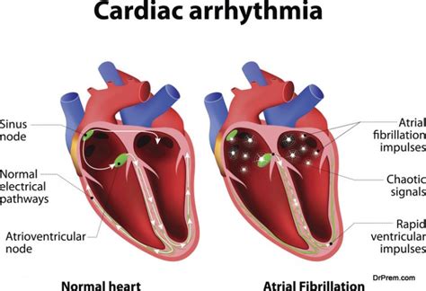 Cardiac Arrhythmia: Symptoms, Diagnosis, and Treatment