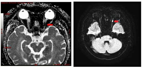 Role of MRI in Posterior ischemic optic neuropathy (PION) - EyeToday