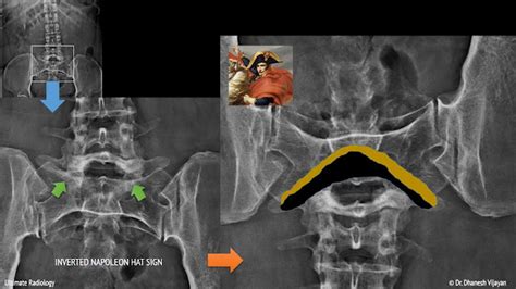 Ultimate Radiology : Inverted Napoleon Hat Sign